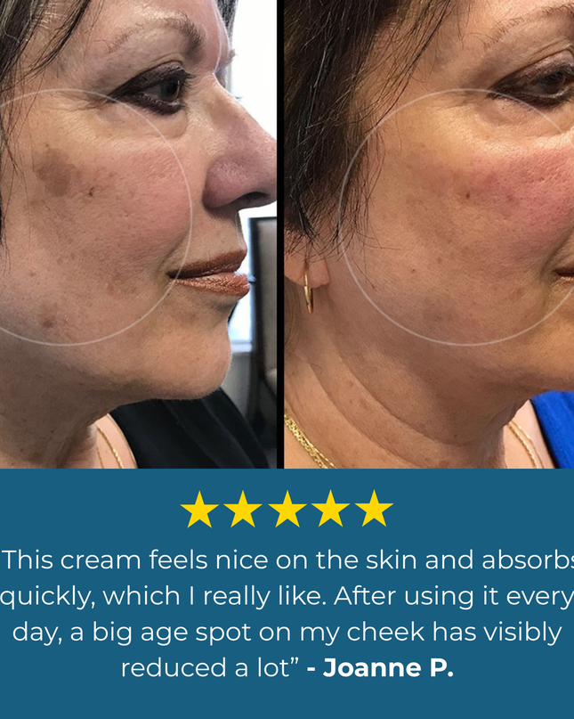 Aloria Age Spot Cream™