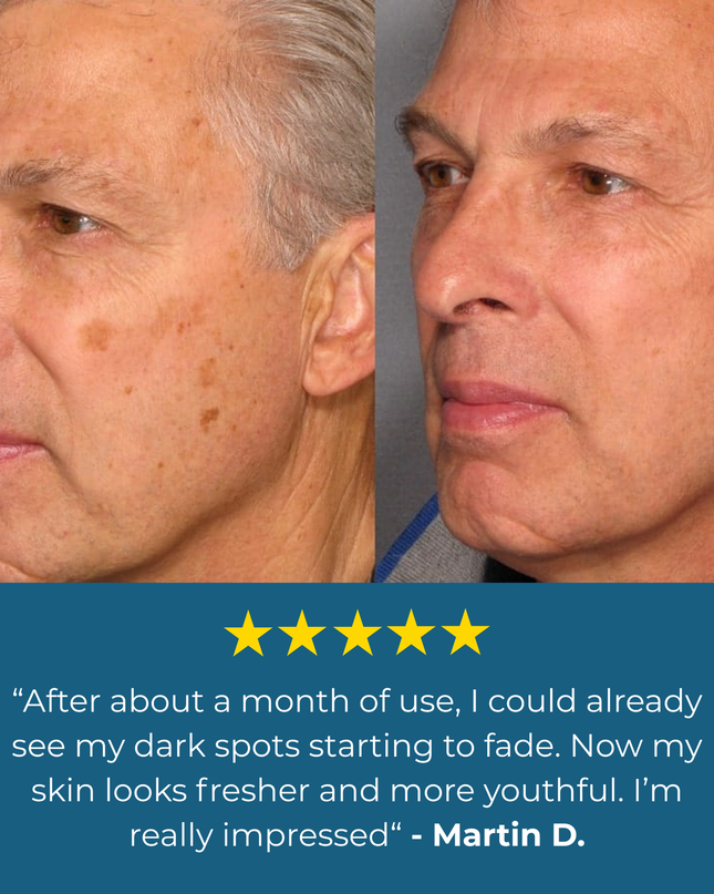 Aloria Age Spot Cream™
